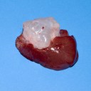 Hepatic cyst