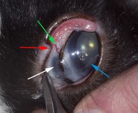 This image shows the eye of a rabbit with glaucoma and staphyloma. The white arrow goes to the staphyloma that is an abnormal protrusion of the contents of the eye through a weak point in the eyeball. The protrusion is generally dark in colour, due to the colour of the inner structures of the eye.  The red arrow goes to a congested episcleral blood vessel. The blue arrow goes to horizontal lines in the front of the eye. These are 'Haab's striae' . The red arrow goes to an extra flap or notch of abnormal eyelid (eyelid dysplasia) that can roll in and irritate the cornea.