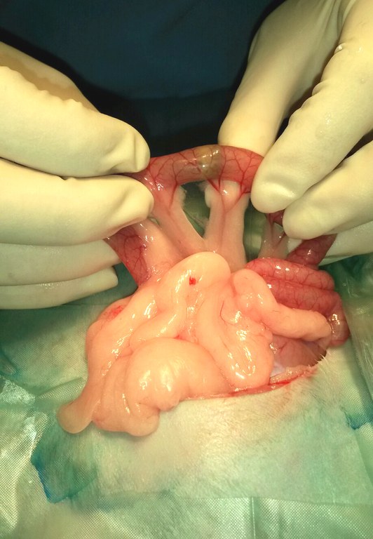 Intestinal foreign body